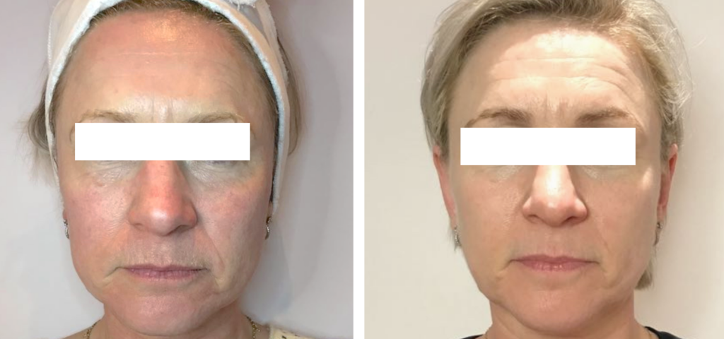 Side-by-side photos of a woman with short fair hair, eyes covered with white rectangles; the left image shows more visible facial lines and uneven skin tone, while the right shows smoother, more even skin.