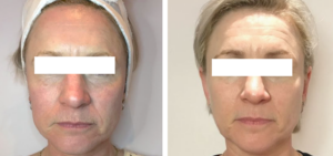 Side-by-side photos of a woman with short fair hair, eyes covered with white rectangles; the left image shows more visible facial lines and uneven skin tone, while the right shows smoother, more even skin.