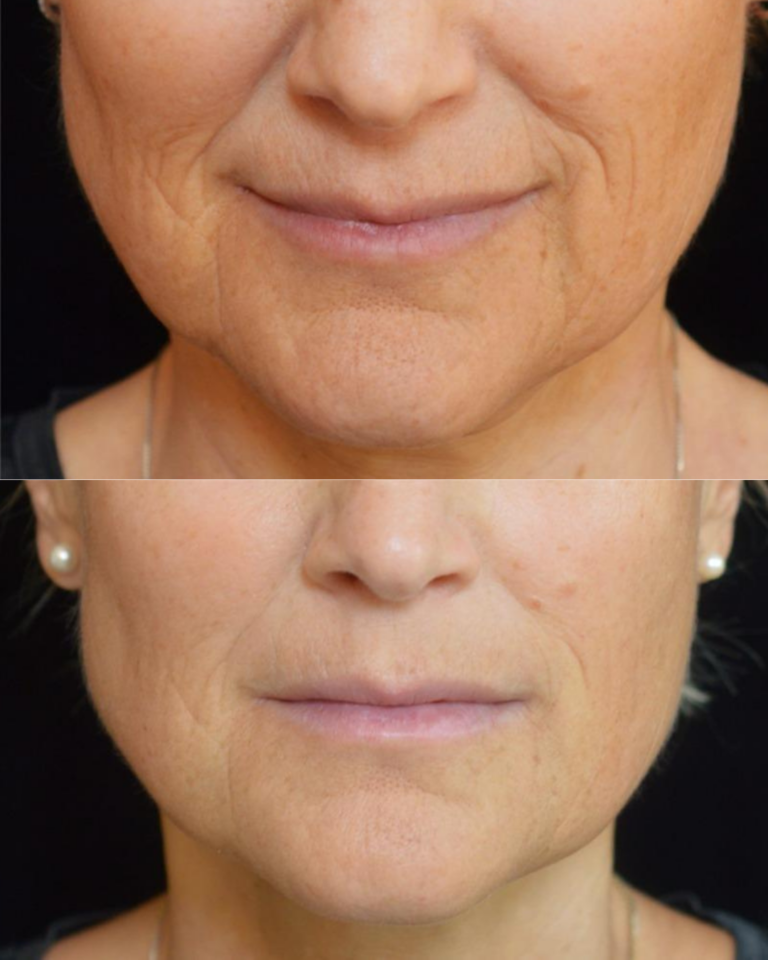 Side-by-side photos show the lower face of a woman before (top) and after (bottom) a cosmetic treatment, with noticeable reduction in wrinkles and smoother skin in the after image.