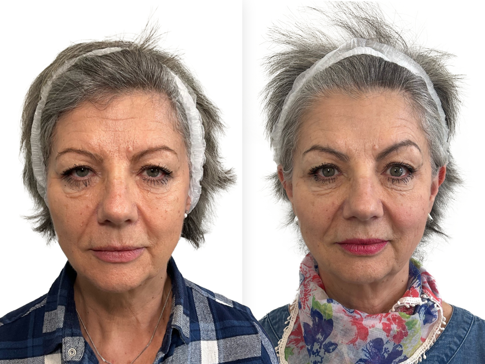 This patient's before & after photos show beautifully natural results after just two JULÄINE™ treatments. Recommended treatment protocol for the best results, is three treatments (one per month).