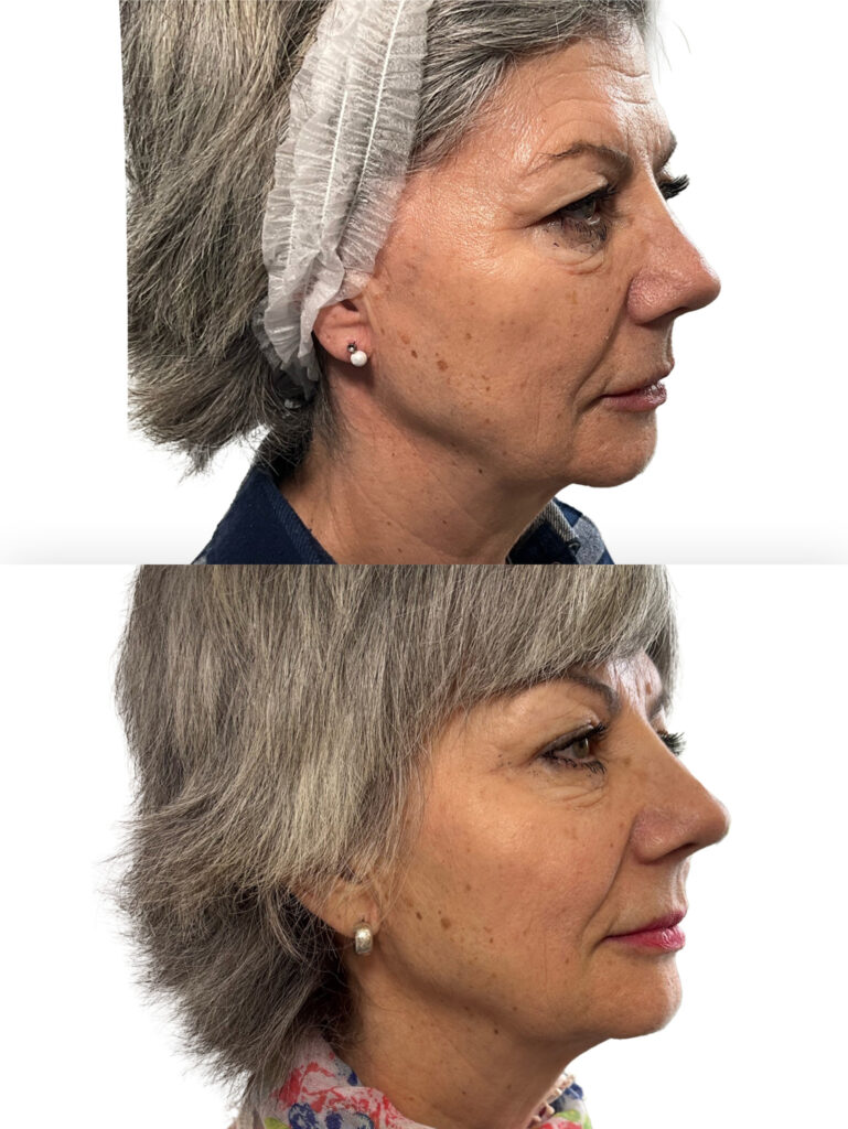 This patient's before & after photos show beautifully natural results after just two JULÄINE™ treatments. Recommended treatment protocol for the best results, is three treatments (one per month).