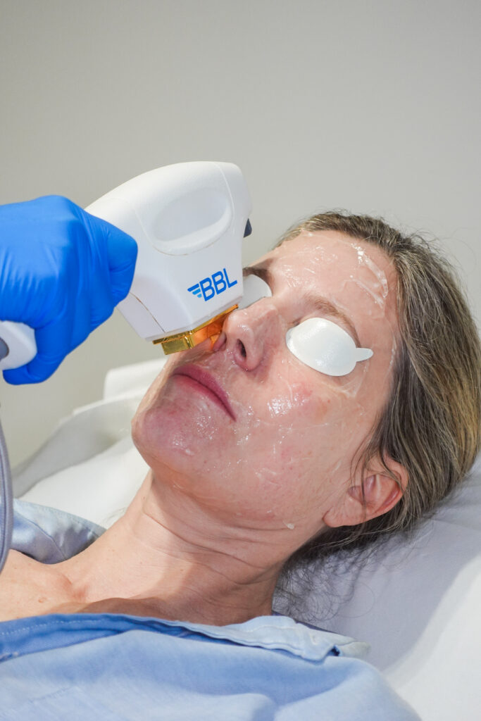 article hero image - Sun Damage Treatment - How BBL Reverses What the Sun Has Done to Your Skin