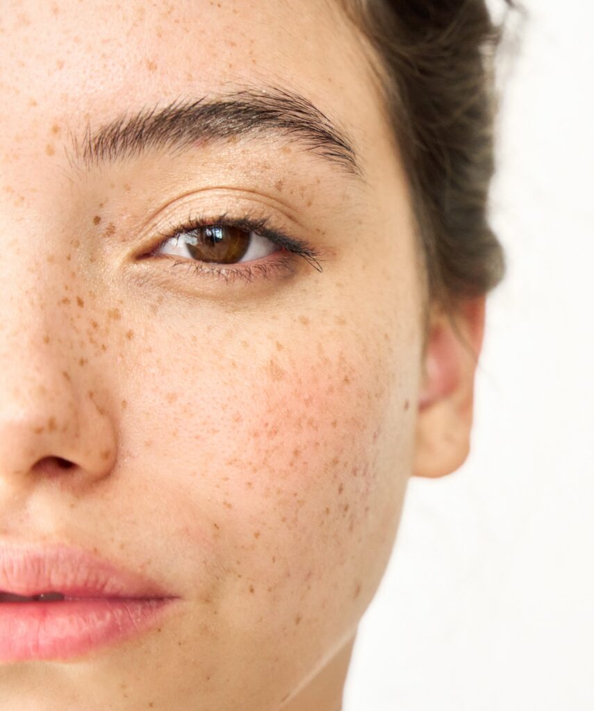 What Causes Dark Spots on the Face? A Doctor's Guide to Pigmentation